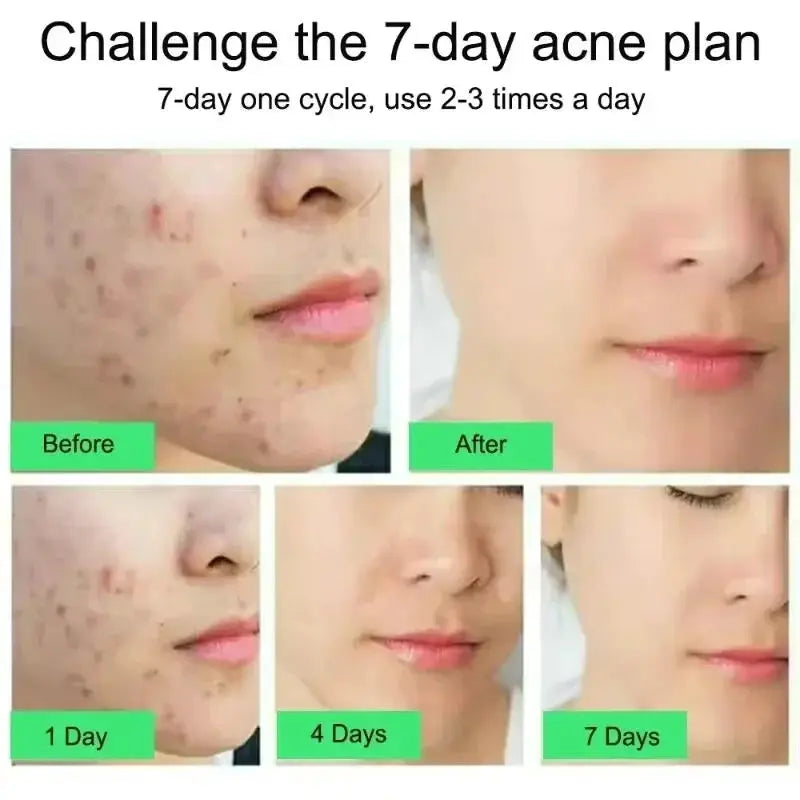 Salicylic Acid Acne Treatment Face Cream For Deep Pore Cleansing Oil Control And Scar Repair Moisturizer