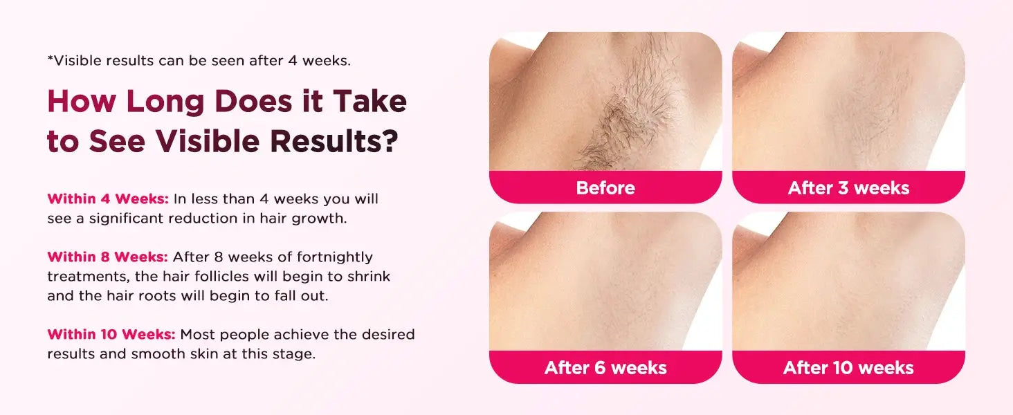 Simples Market IPL hair removal device banner showing before and after panels (3/6/10 weeks) on pink background.
