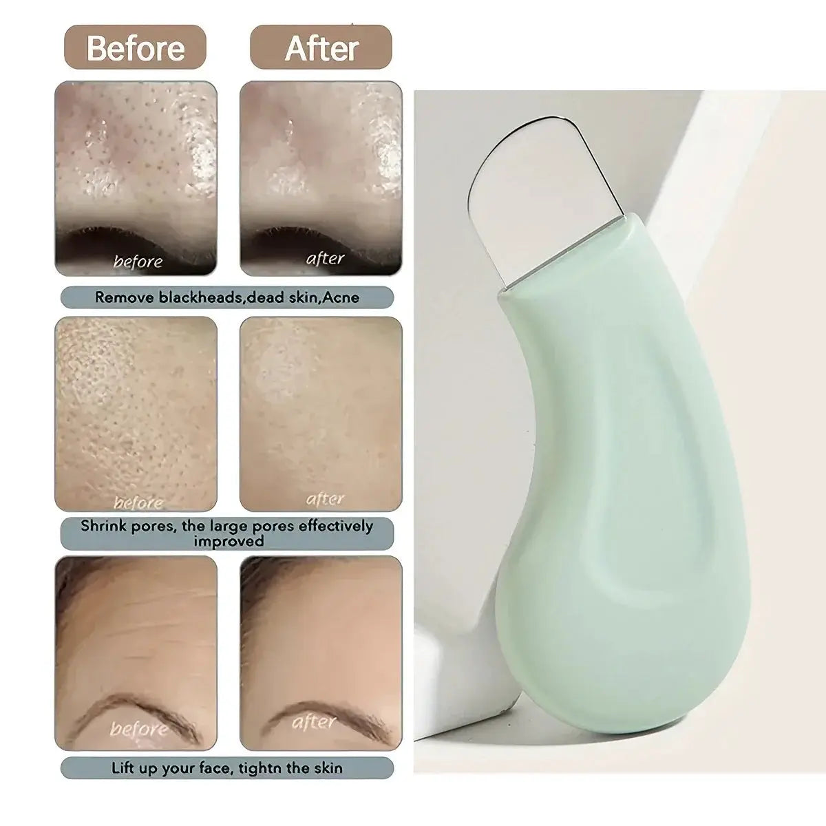 Blackhead and Whitehead Removal Tool for Nose and Face Skin Pore Cleaner Skin Care Tools for Women