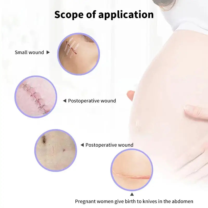 5 Wound Closure Strips For Postpartum Wound Repair Suture Free Medical Adhesive Tape For Cosmetic Surgery
