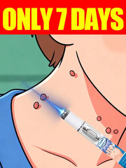 Blue Light Wart Pen For Neck Warts Non Electric Wart Care Tool Safe At Home For Easy Home Use