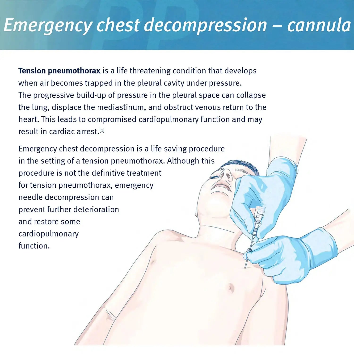 Sanke Rescue pneumothorax needle decompression kit – chest catheter needle for first aid, Simples Market