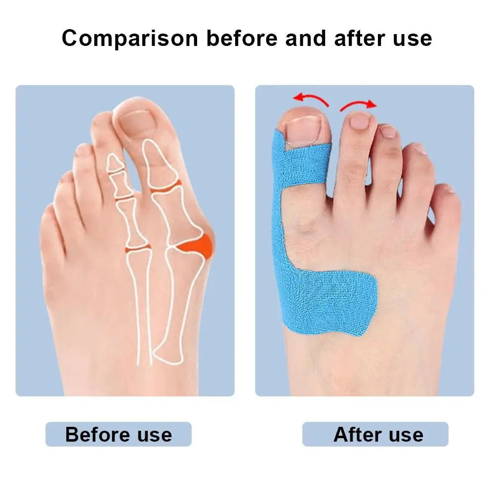 Kinesiology tape set, 10pcs pre-cut for bunions; blue tape on the big toe for support (before/after)