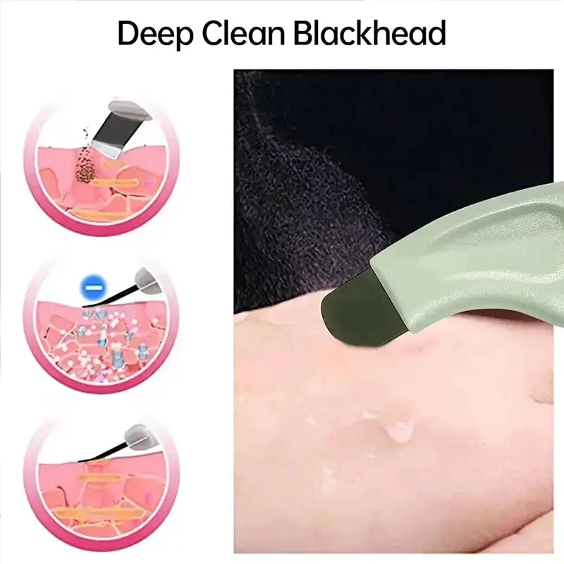 Blackhead And Whitehead Removal Tool For Nose And Face Pore Cleaner