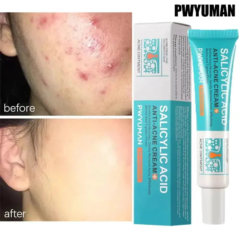 Salicylic Acid Acne Treatment Face Cream For Deep Pore Cleansing Oil Control And Scar Repair Moisturizer