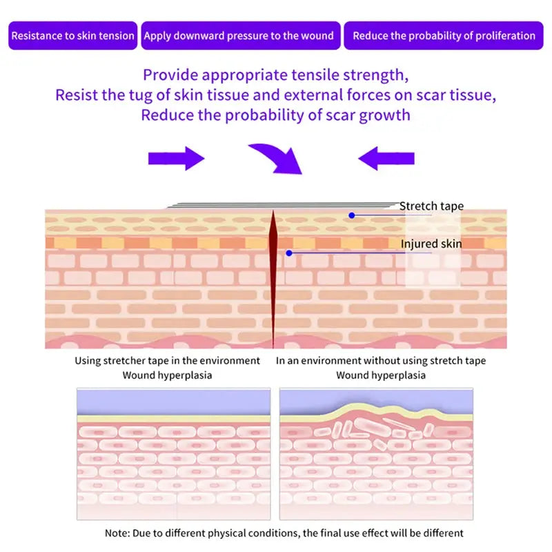 5 Wound Closure Strips For Postpartum Wound Repair Suture Free Medical Adhesive Tape For Cosmetic Surgery