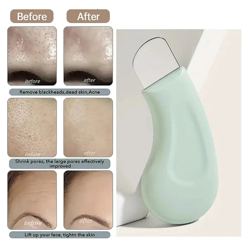 Blackhead And Whitehead Removal Tool For Nose And Face Pore Cleaner