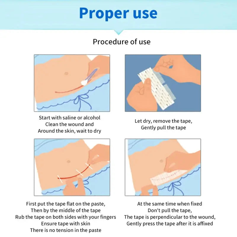 5 Wound Closure Strips For Postpartum Wound Repair Suture Free Medical Adhesive Tape For Cosmetic Surgery