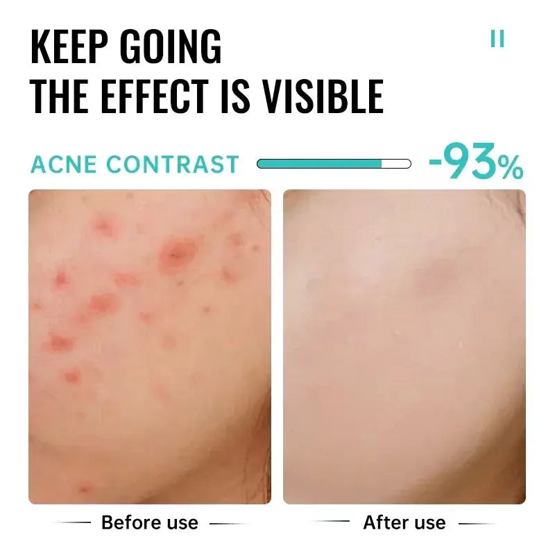 Salicylic Acid Acne Treatment Face Cream For Deep Pore Cleansing Oil Control And Scar Repair Moisturizer