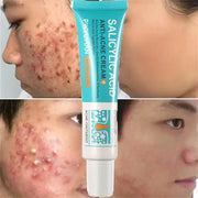 Salicylic Acid Acne Treatment Face Cream For Deep Pore Cleansing Oil Control And Scar Repair Moisturizer