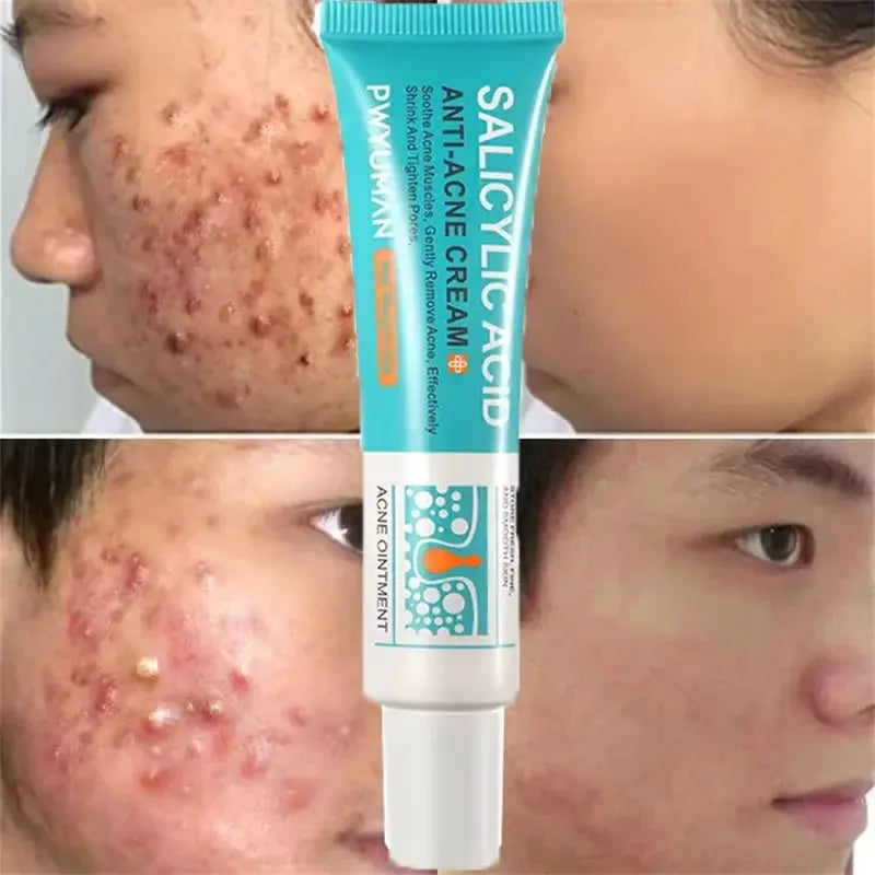 Salicylic Acid Acne Treatment Face Cream For Deep Pore Cleansing Oil Control And Scar Repair Moisturizer